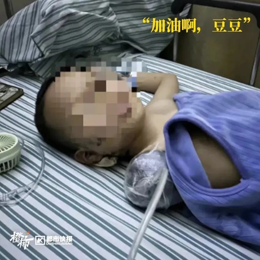 被鞭炮炸伤的截肢男孩可能还需要两三年才能再次接受手术,体内残留的碎片才会被彻底清除